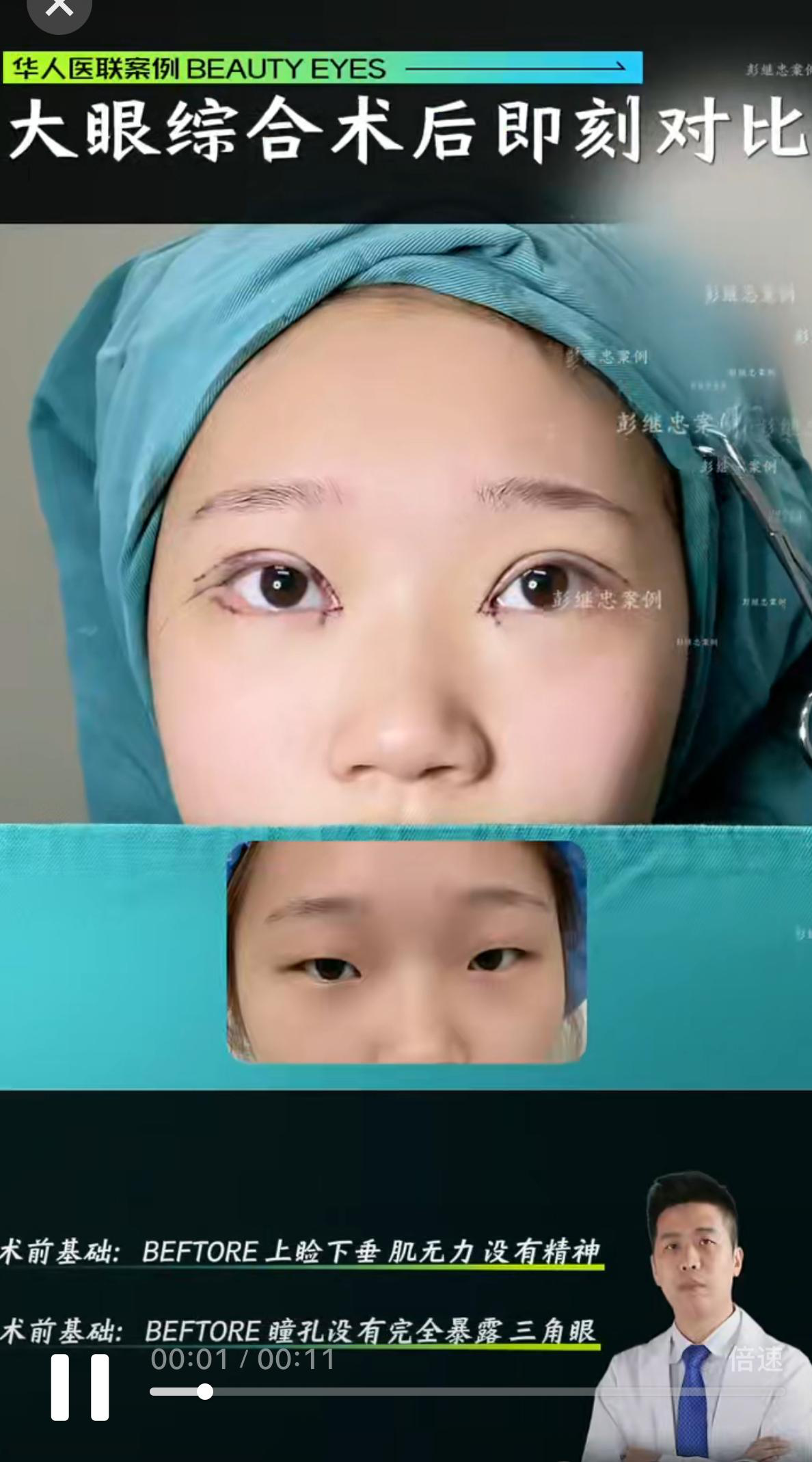 眼综合手术案例 01