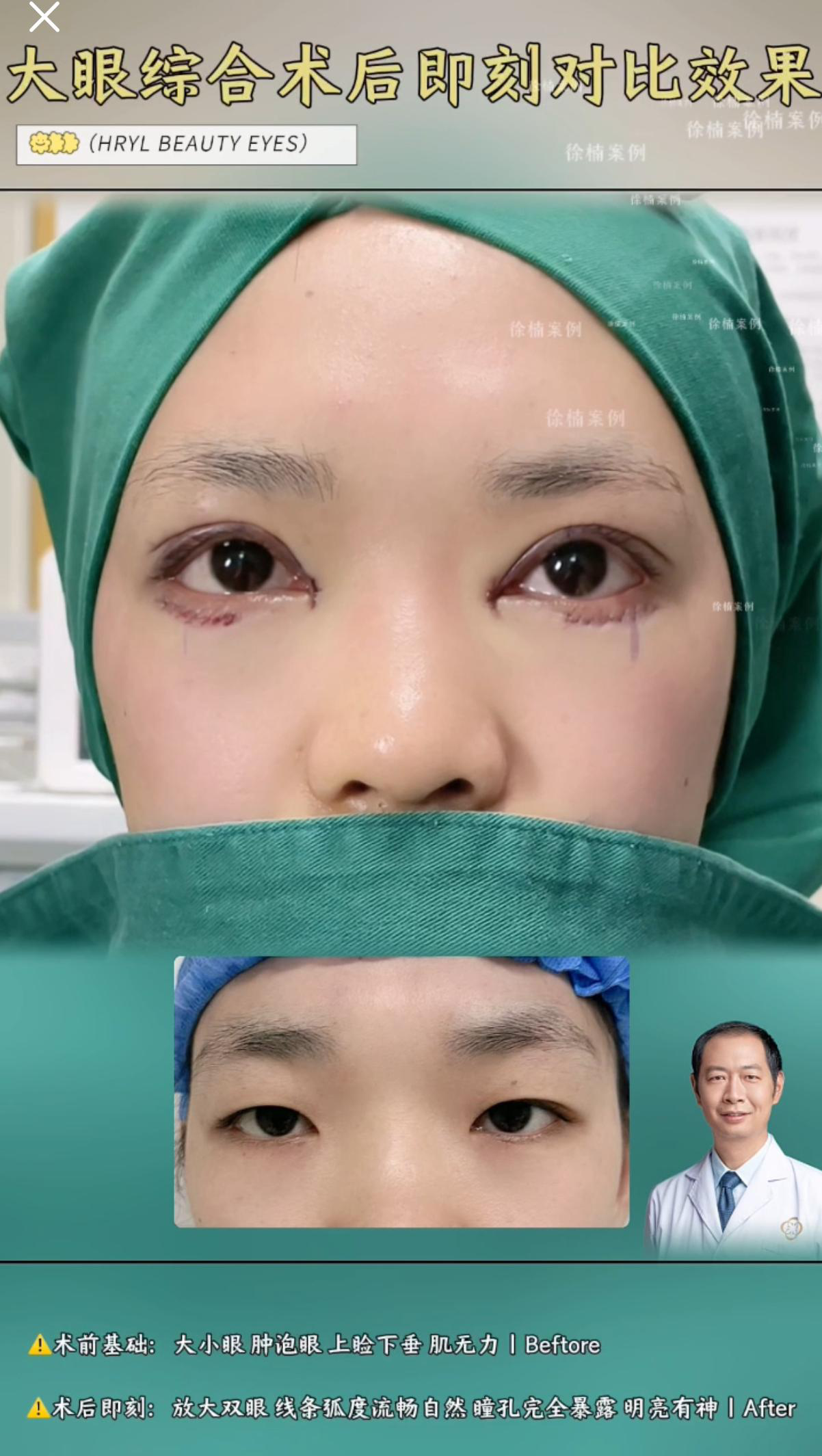 眼综合手术案例 02