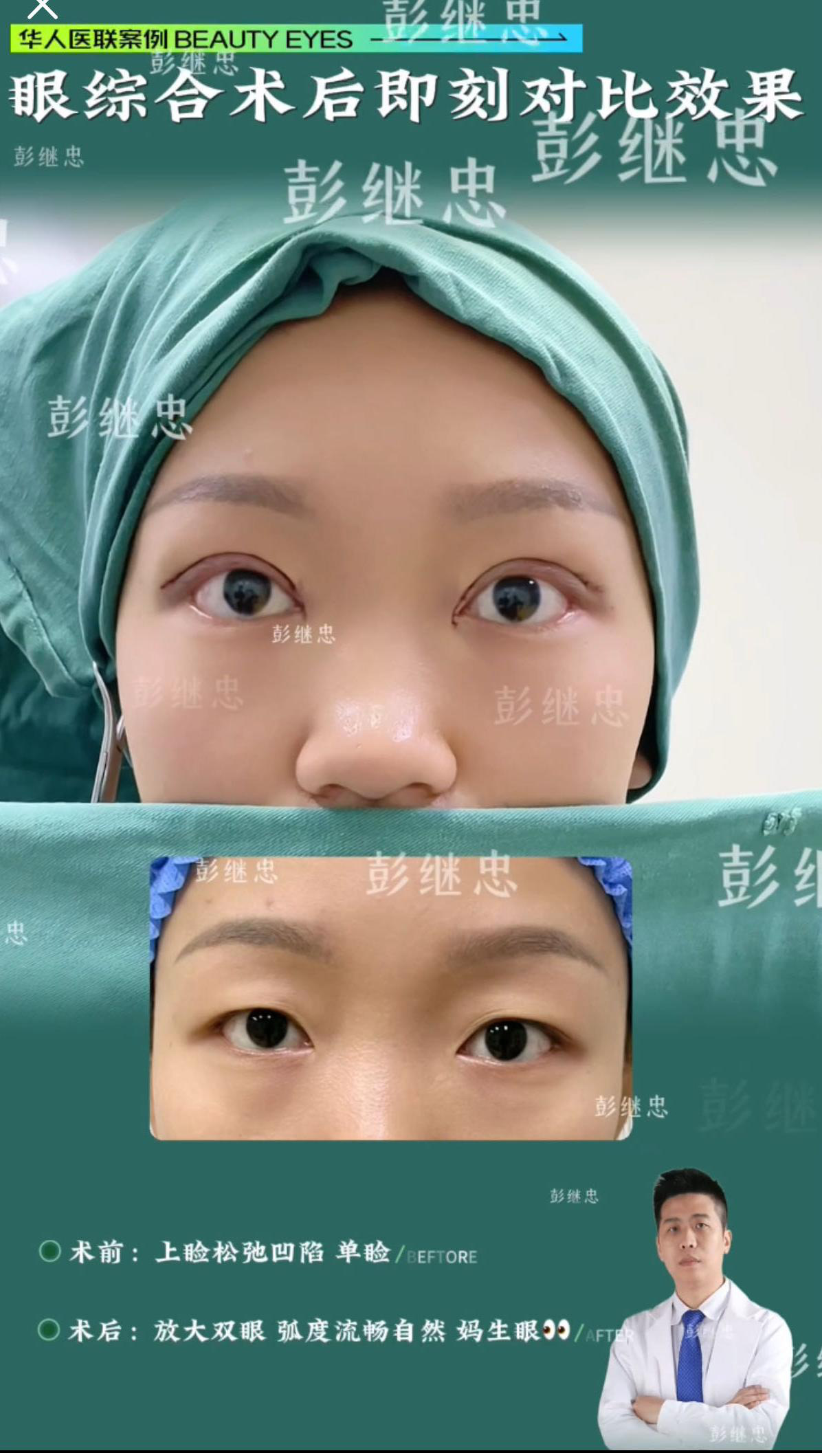 眼综合手术案例 03