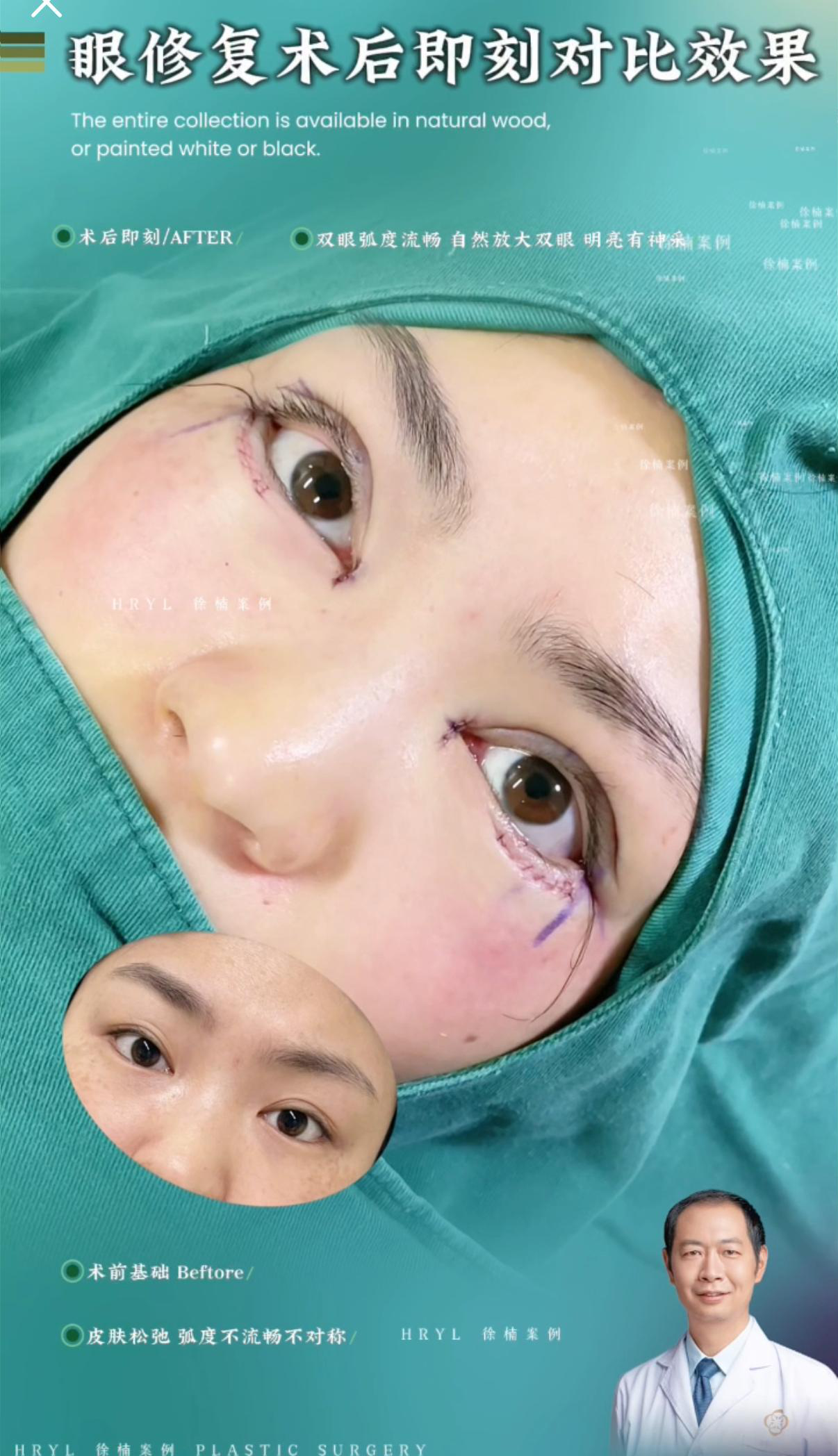眼综合手术案例 04