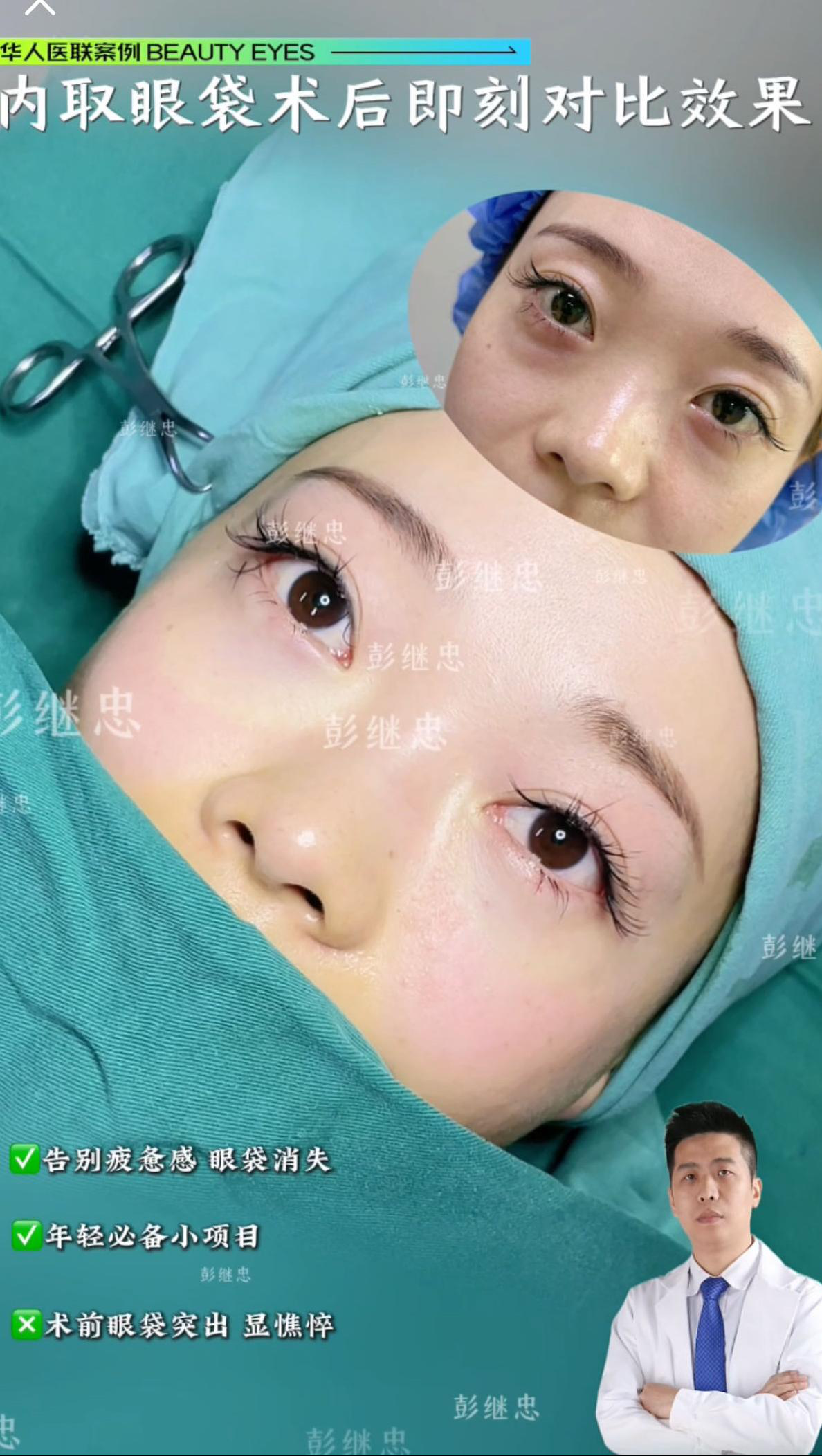 眼周年轻化案例 02