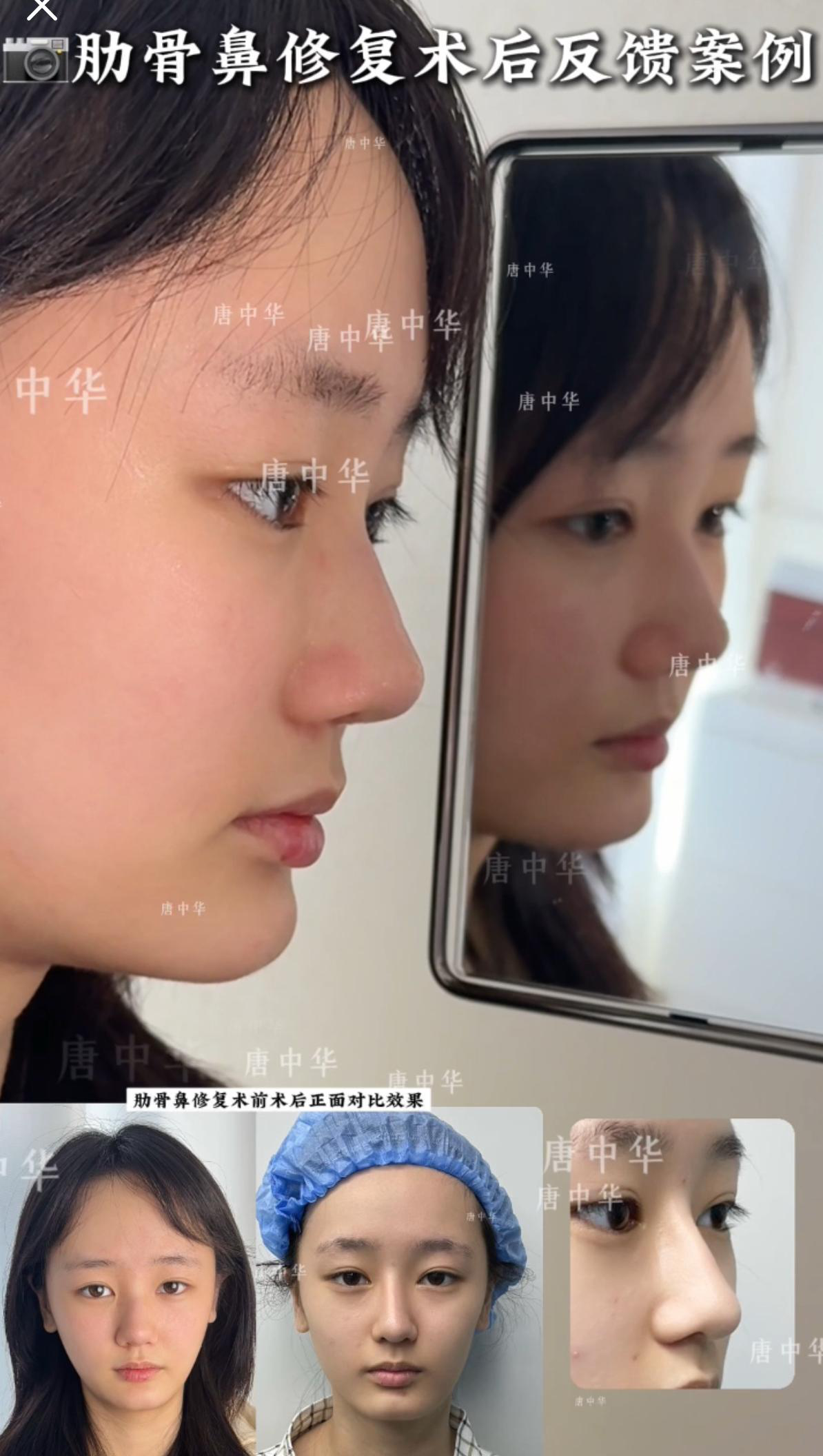 鼻综合案例 01