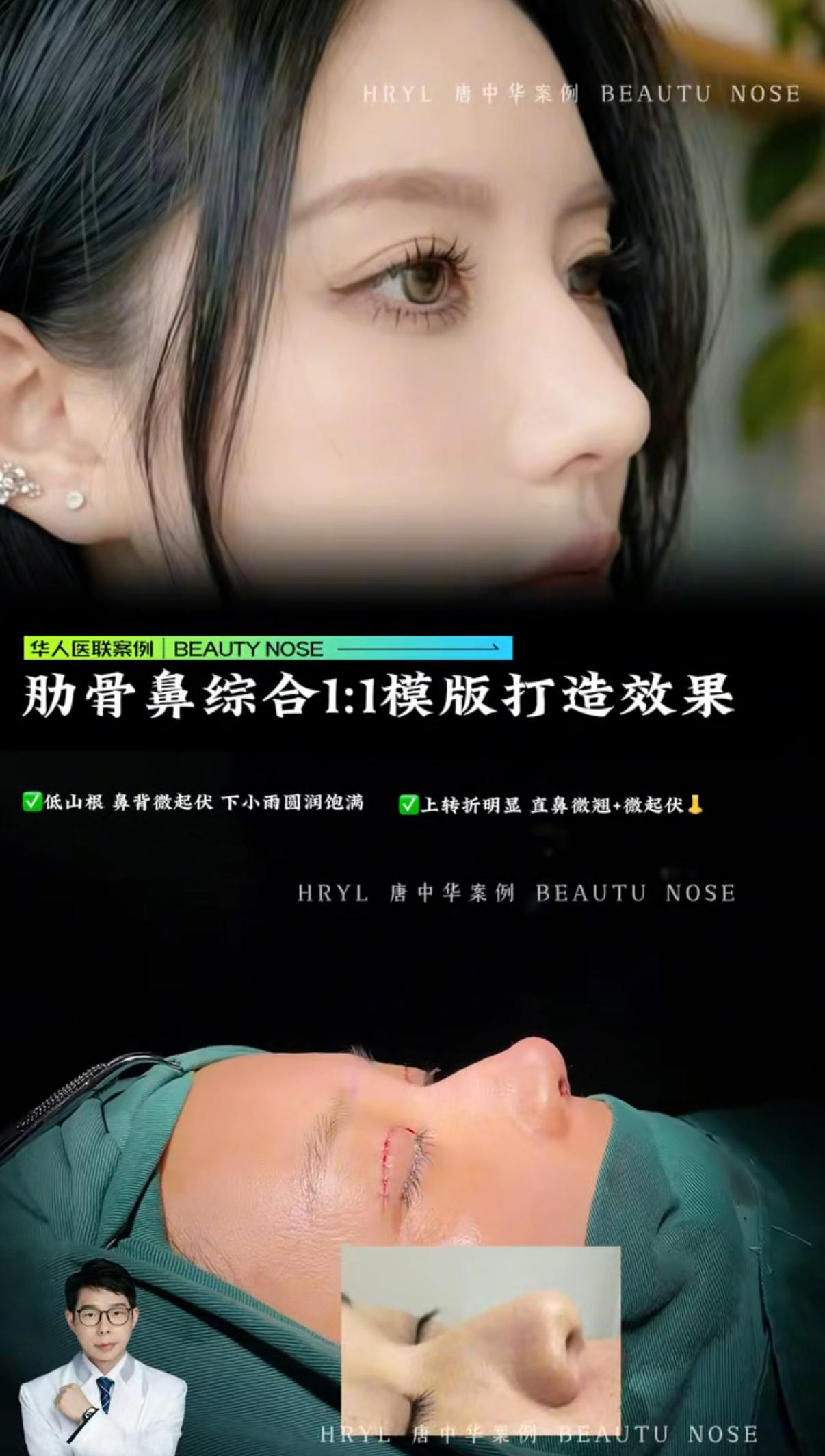 鼻综合案例 02