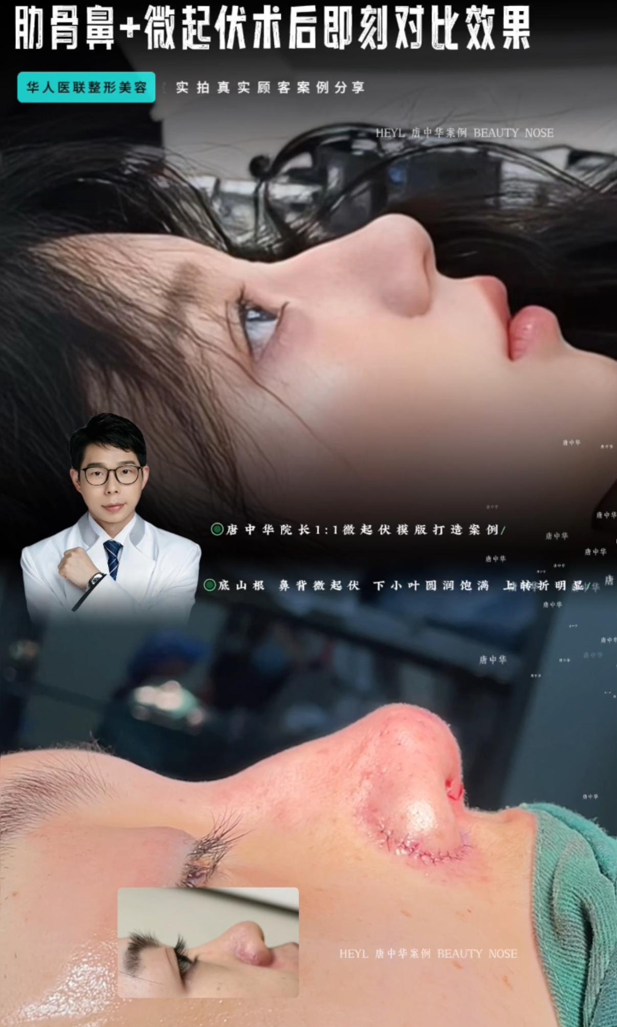 鼻综合案例 03