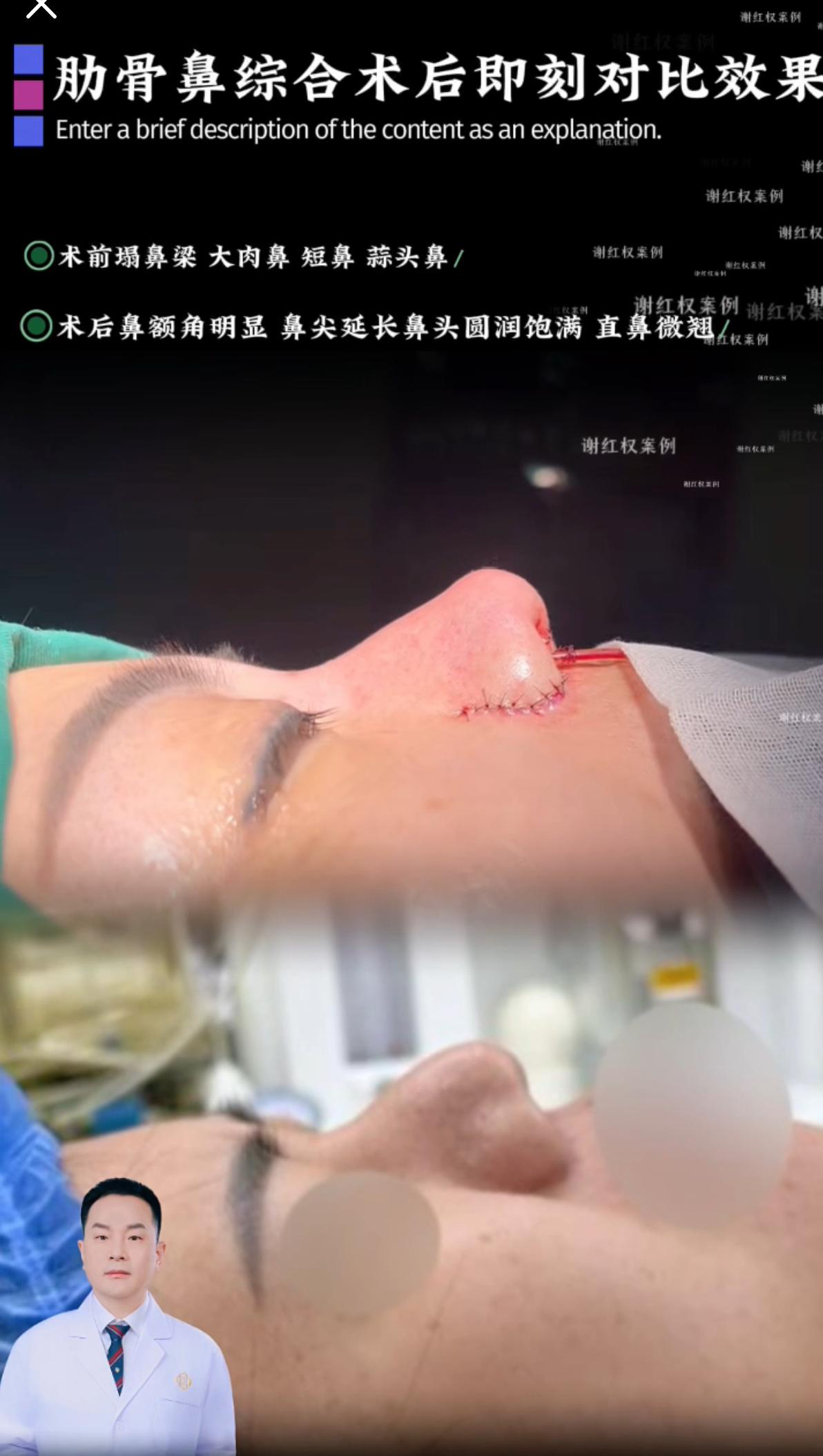 鼻综合案例 05