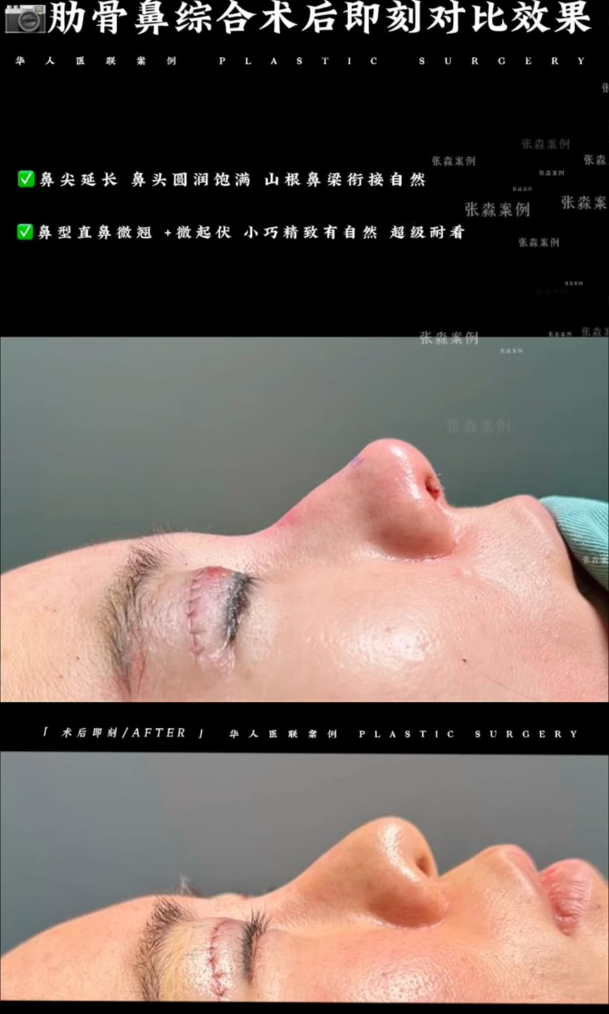 鼻综合案例 07