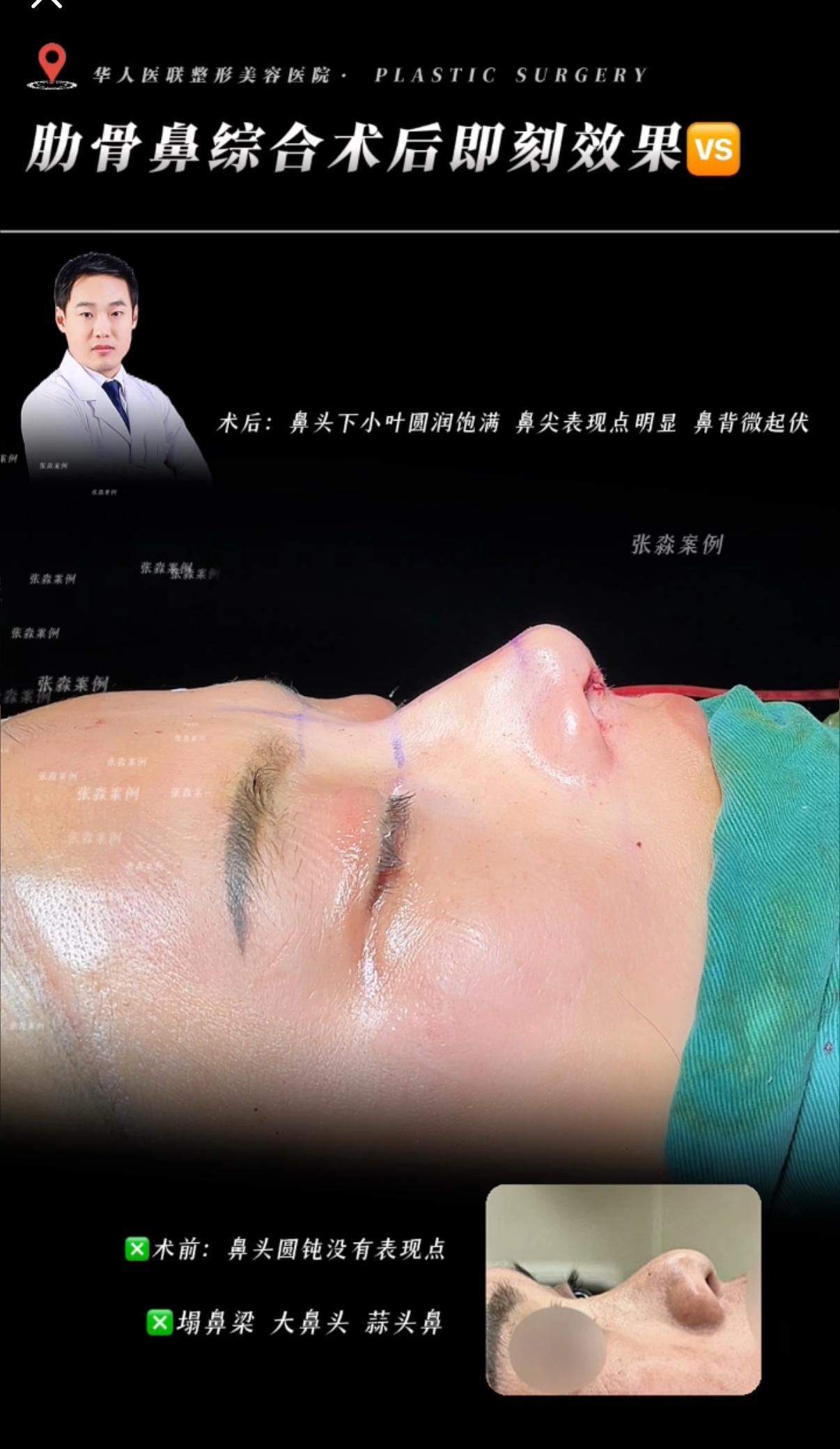鼻综合案例 08