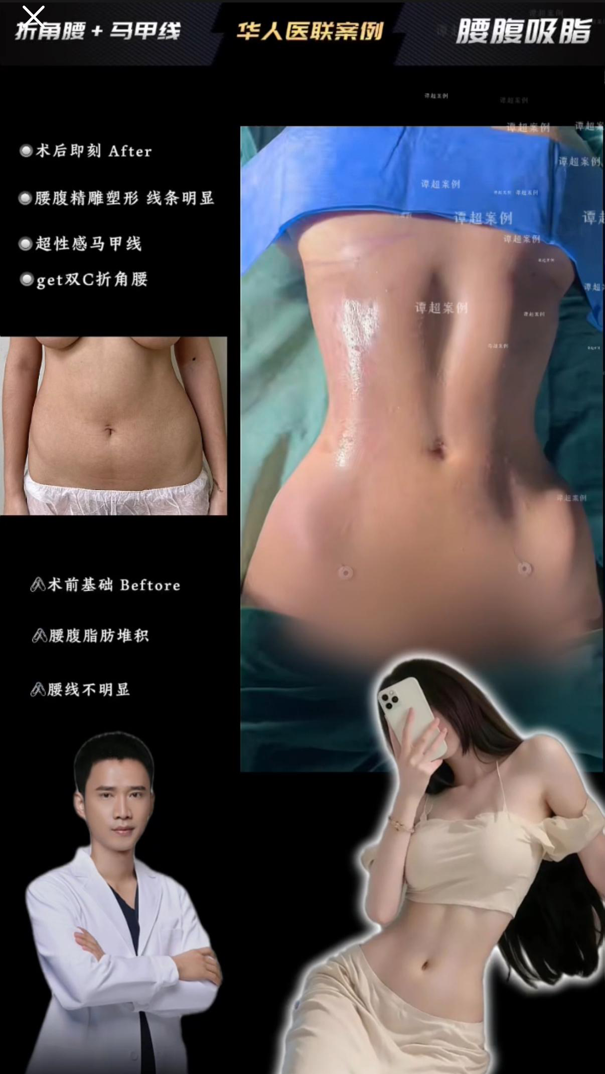 马甲线折角腰案例 01