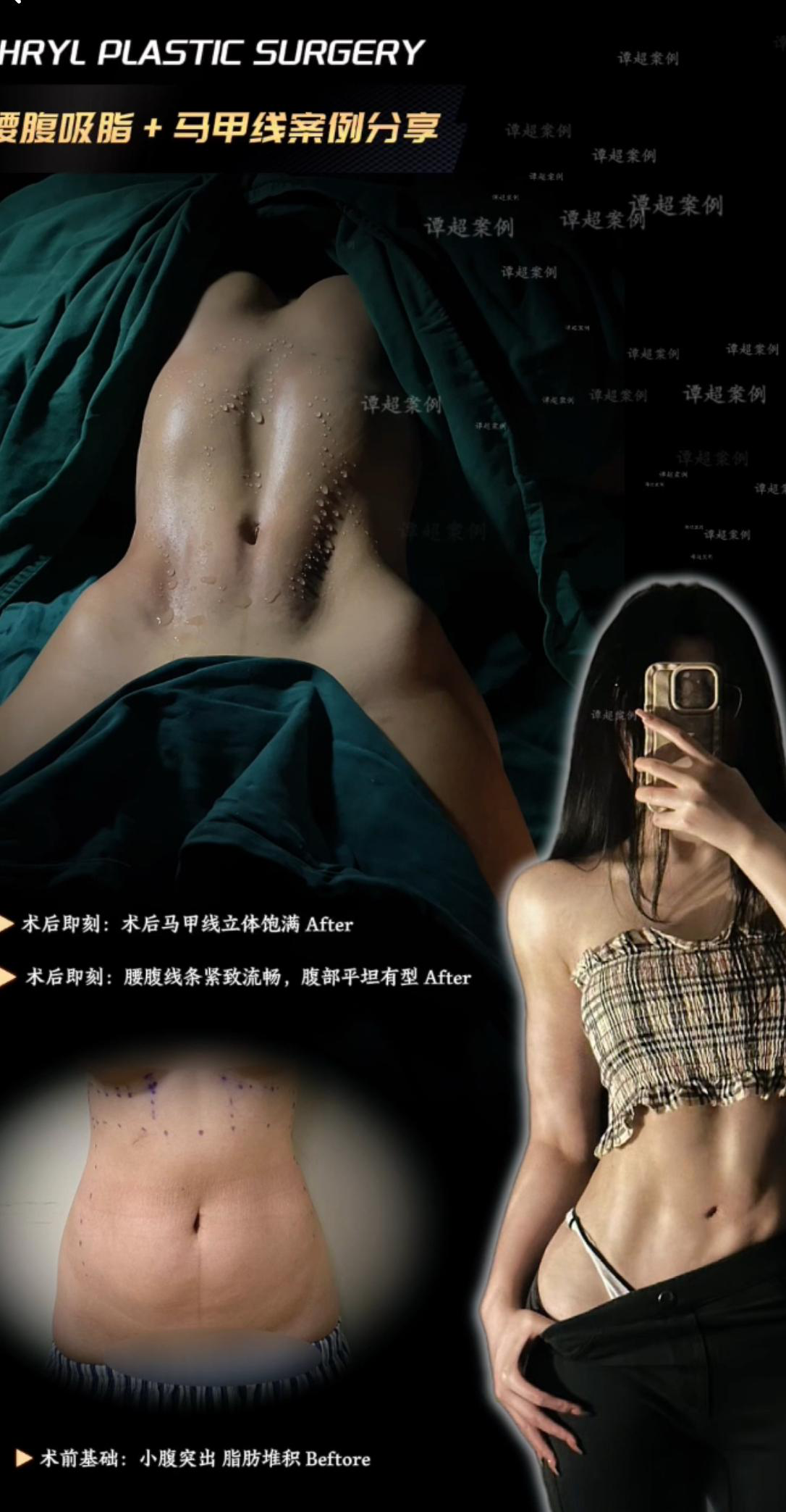 马甲线折角腰案例 02