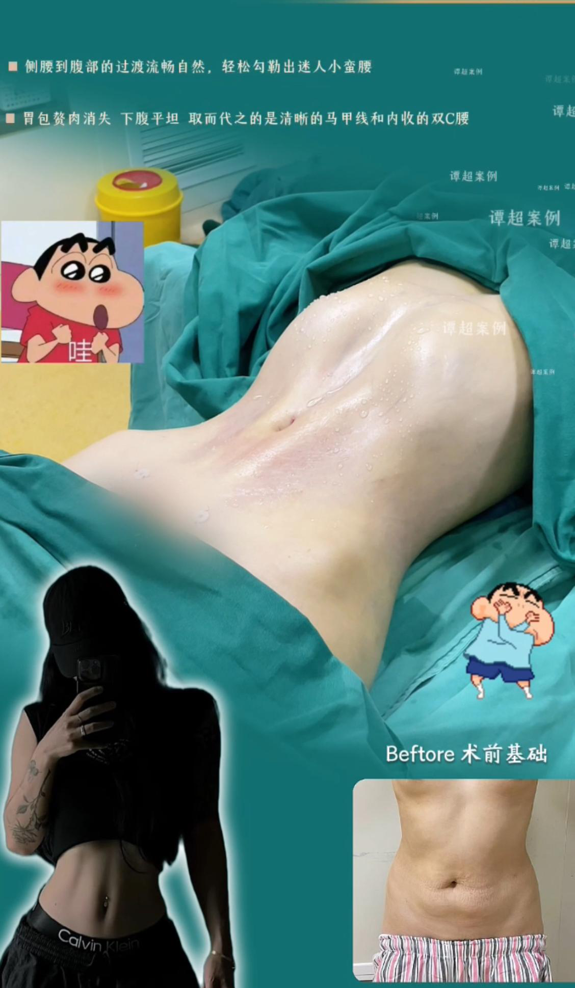 马甲线折角腰案例 03