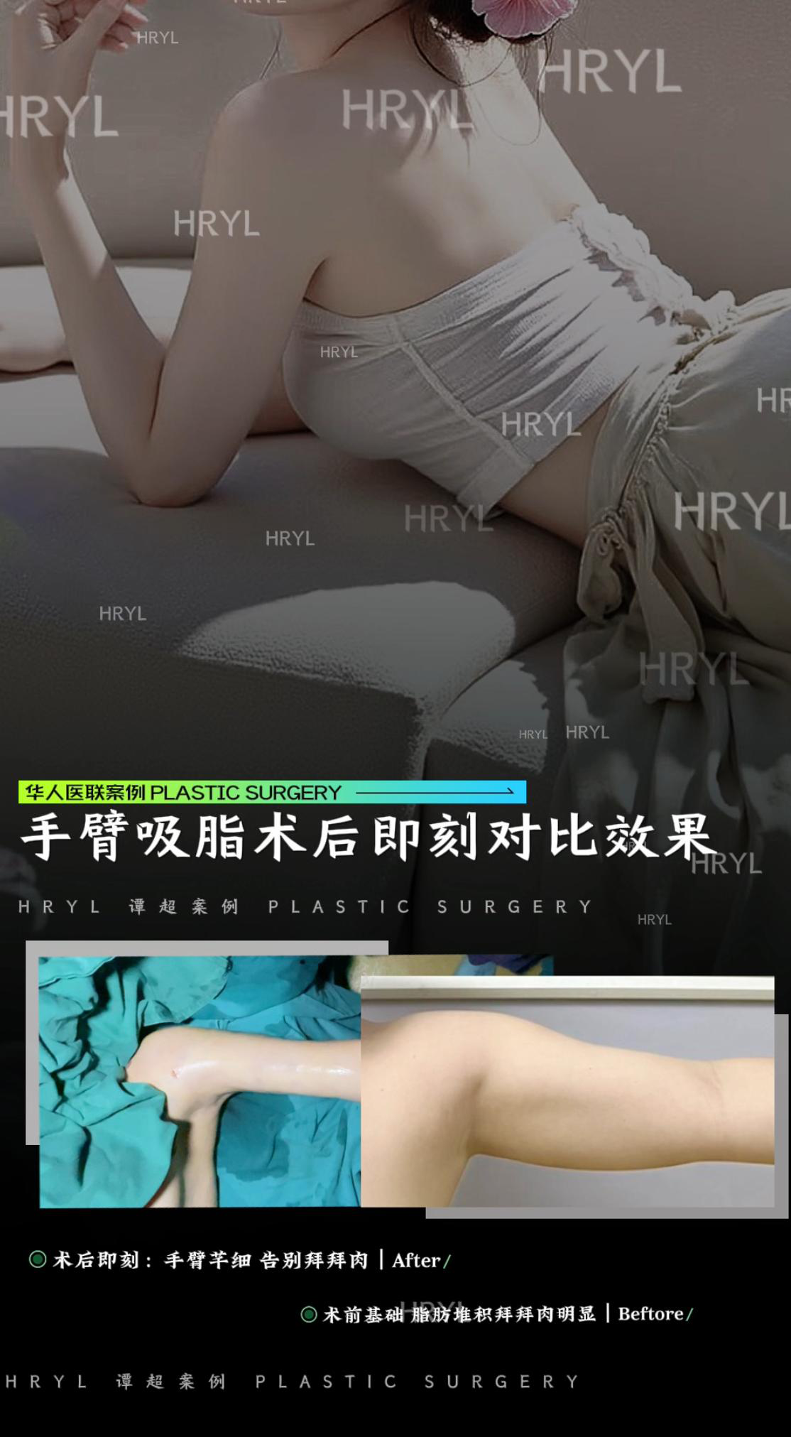 吸脂手术案例 02