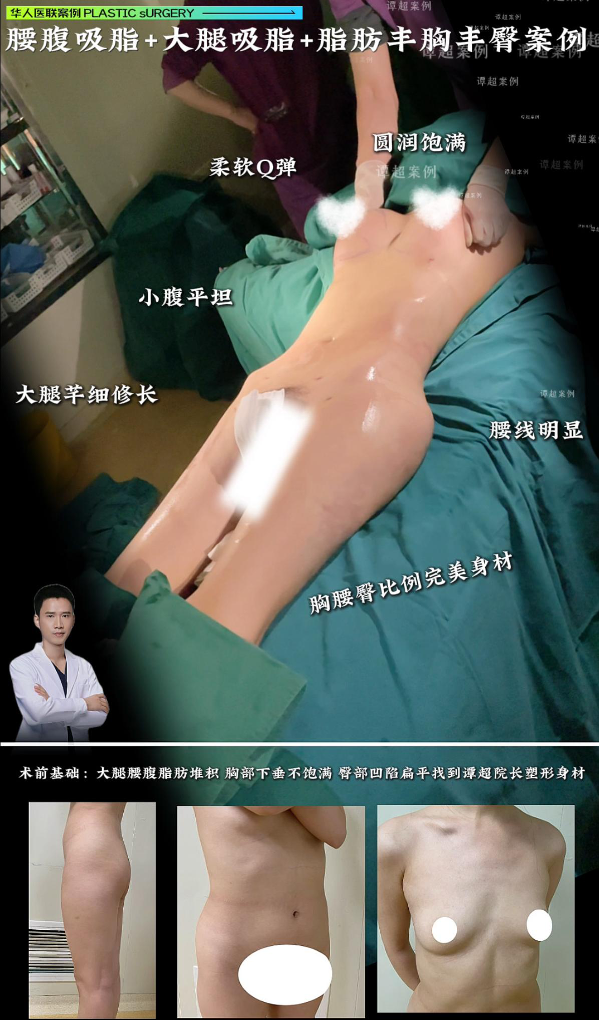 吸脂手术案例 03