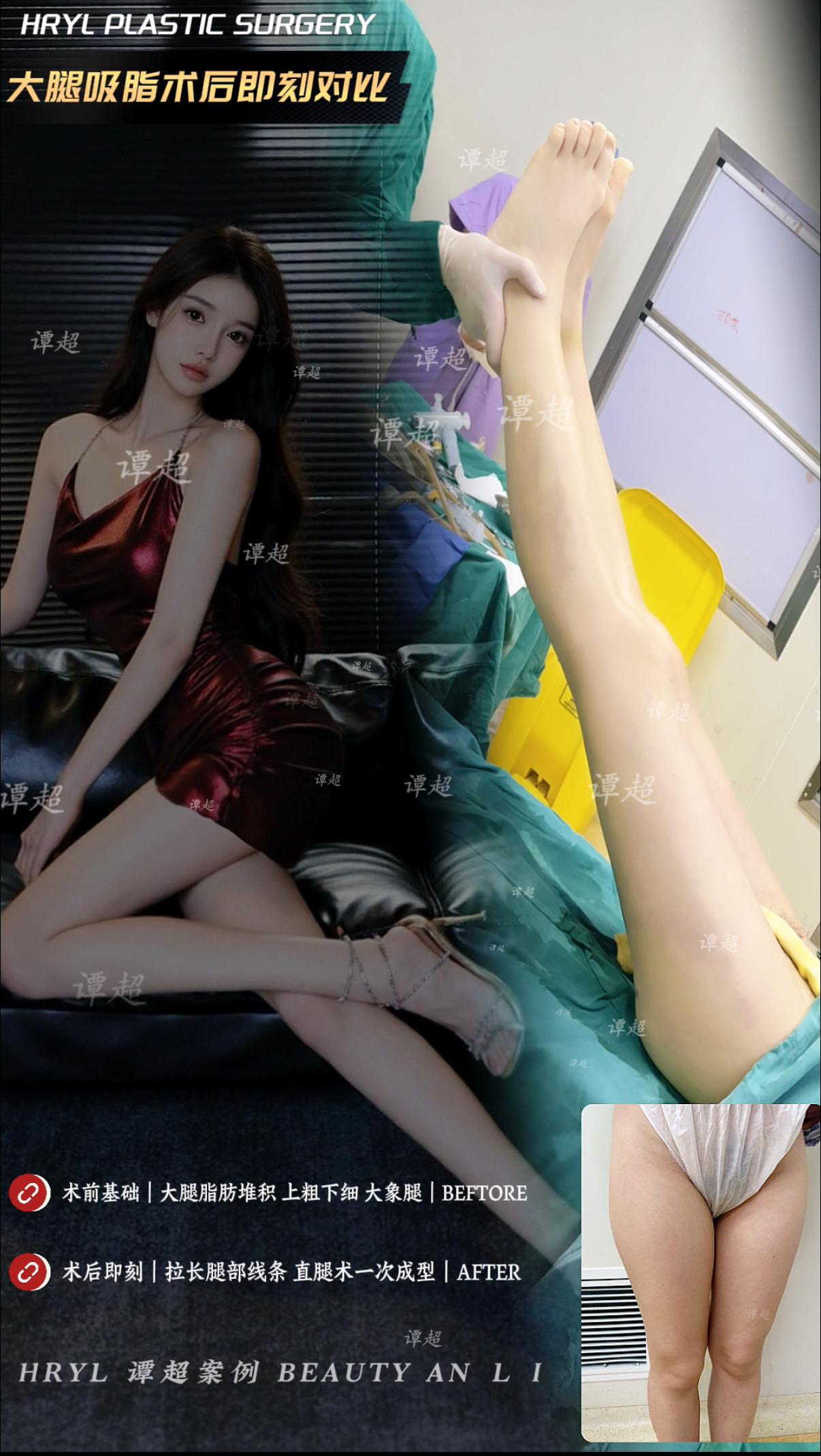 吸脂手术案例 04