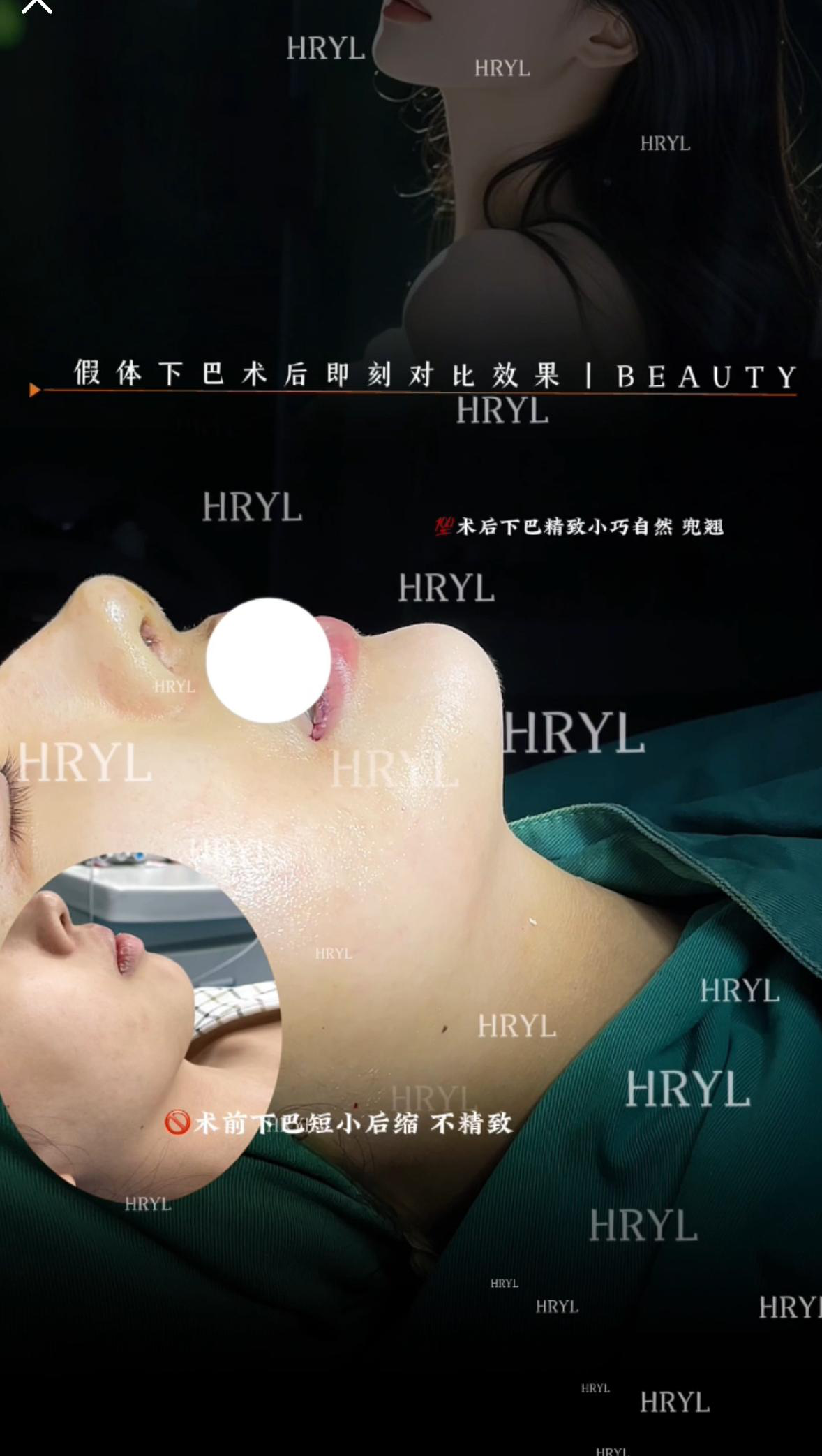 假体下巴案例 01
