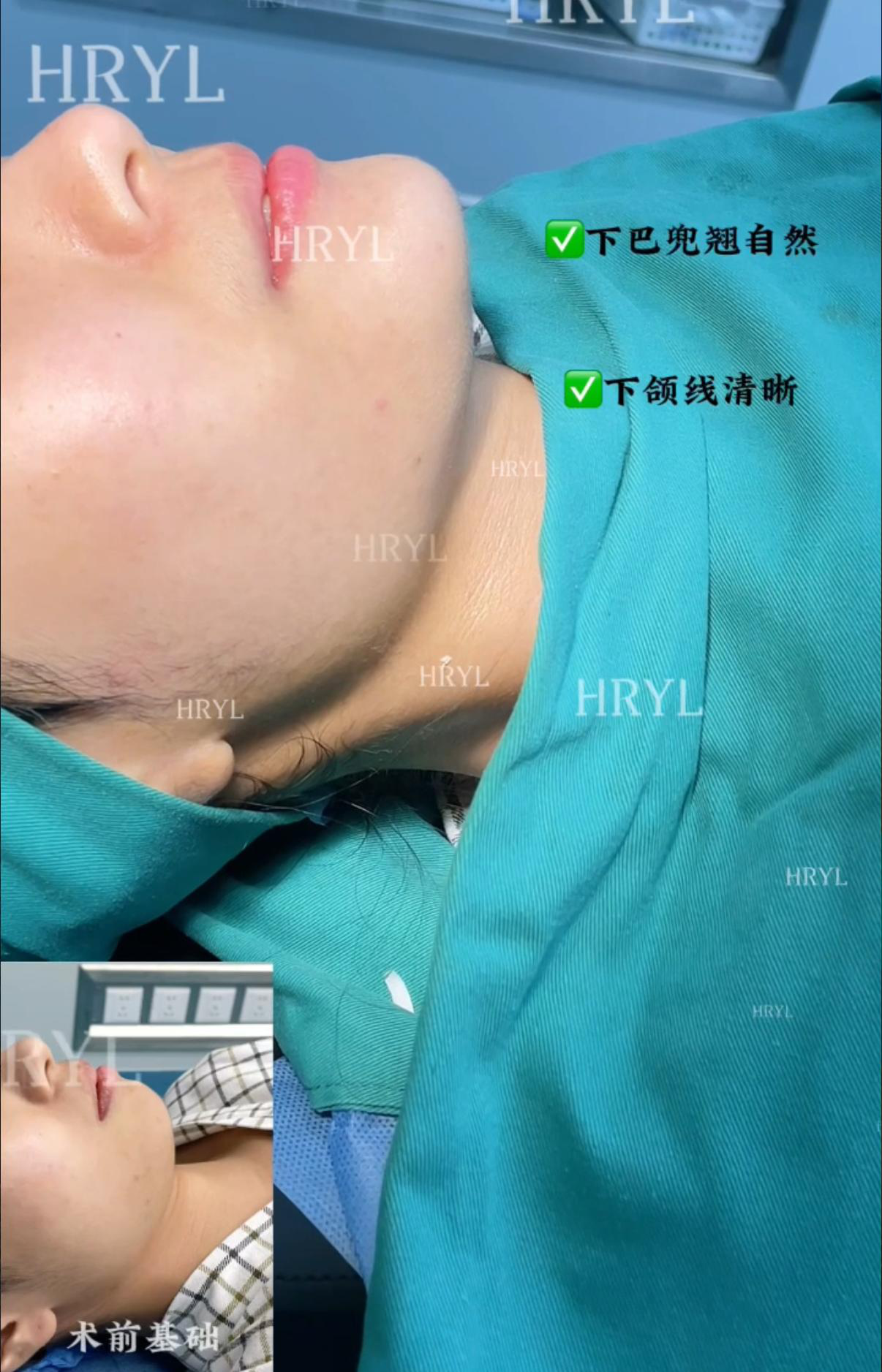 假体下巴案例 02