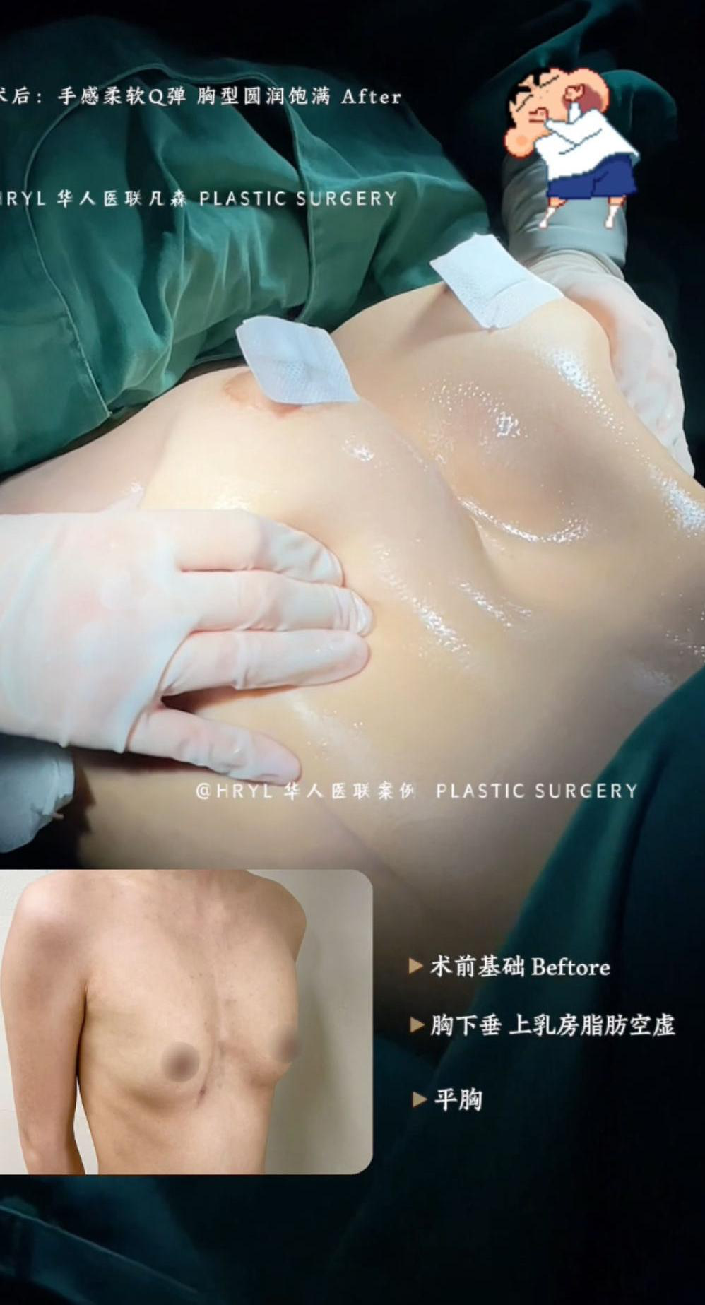 胸部整形案例 03