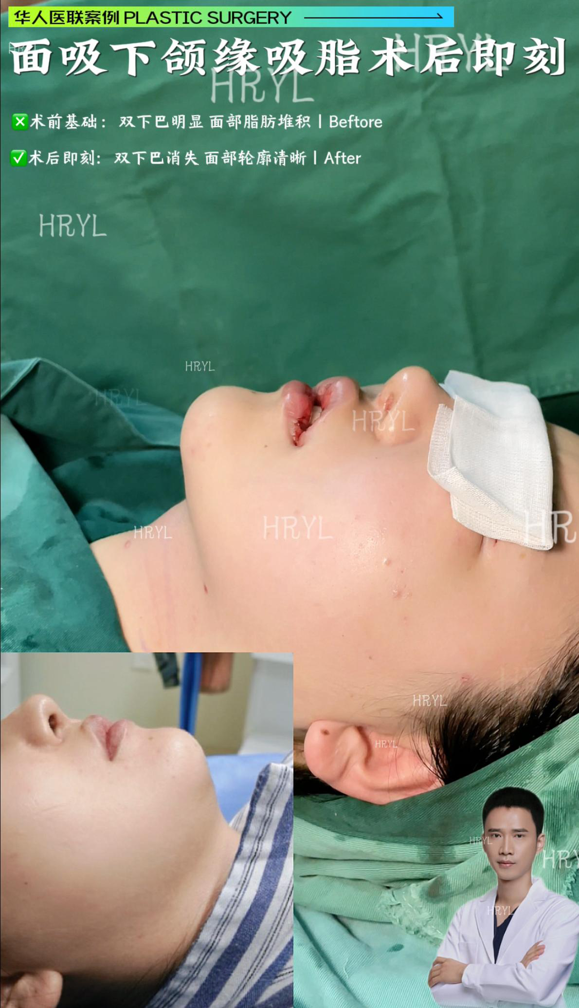 轮廓整形案例 01