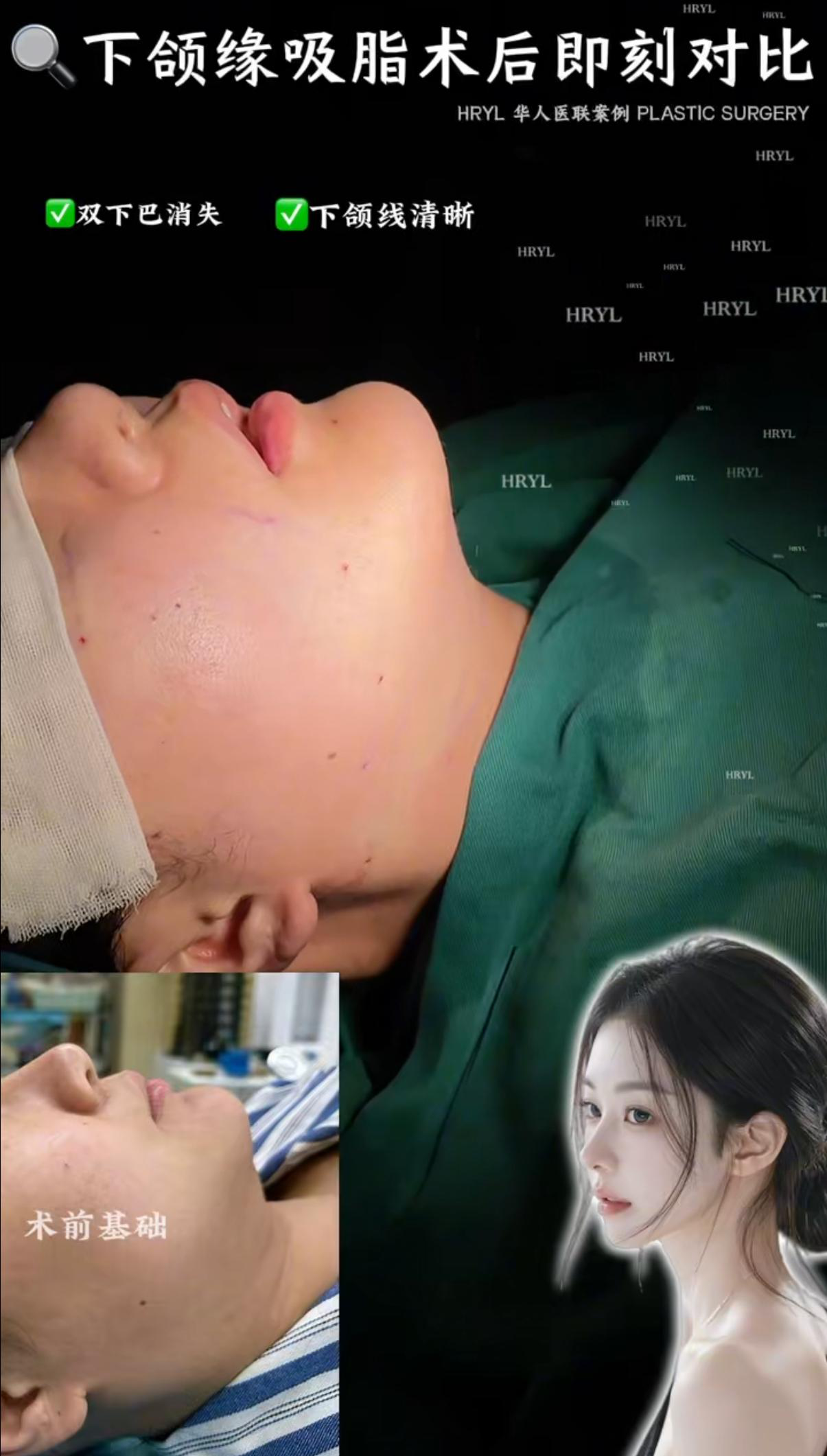 轮廓整形案例 03