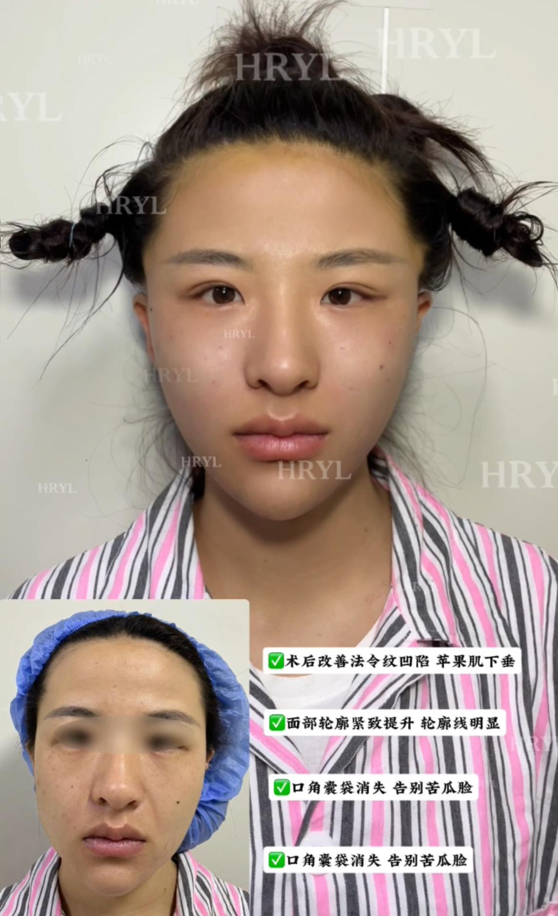 轮廓整形案例 04