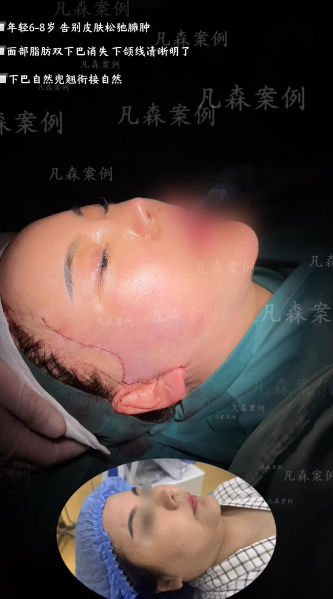 轮廓整形案例 05
