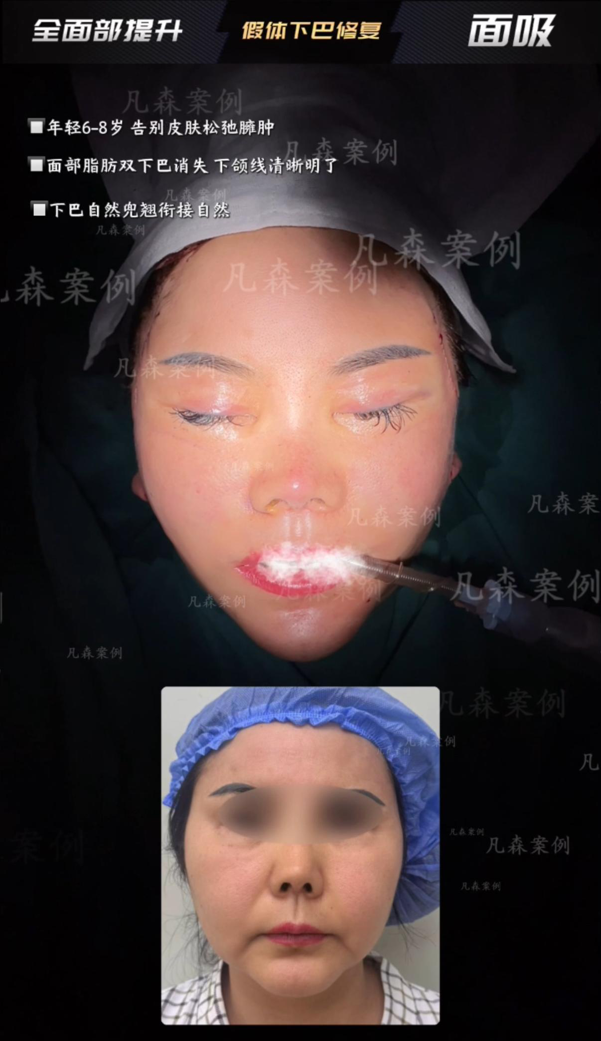 轮廓整形案例 06
