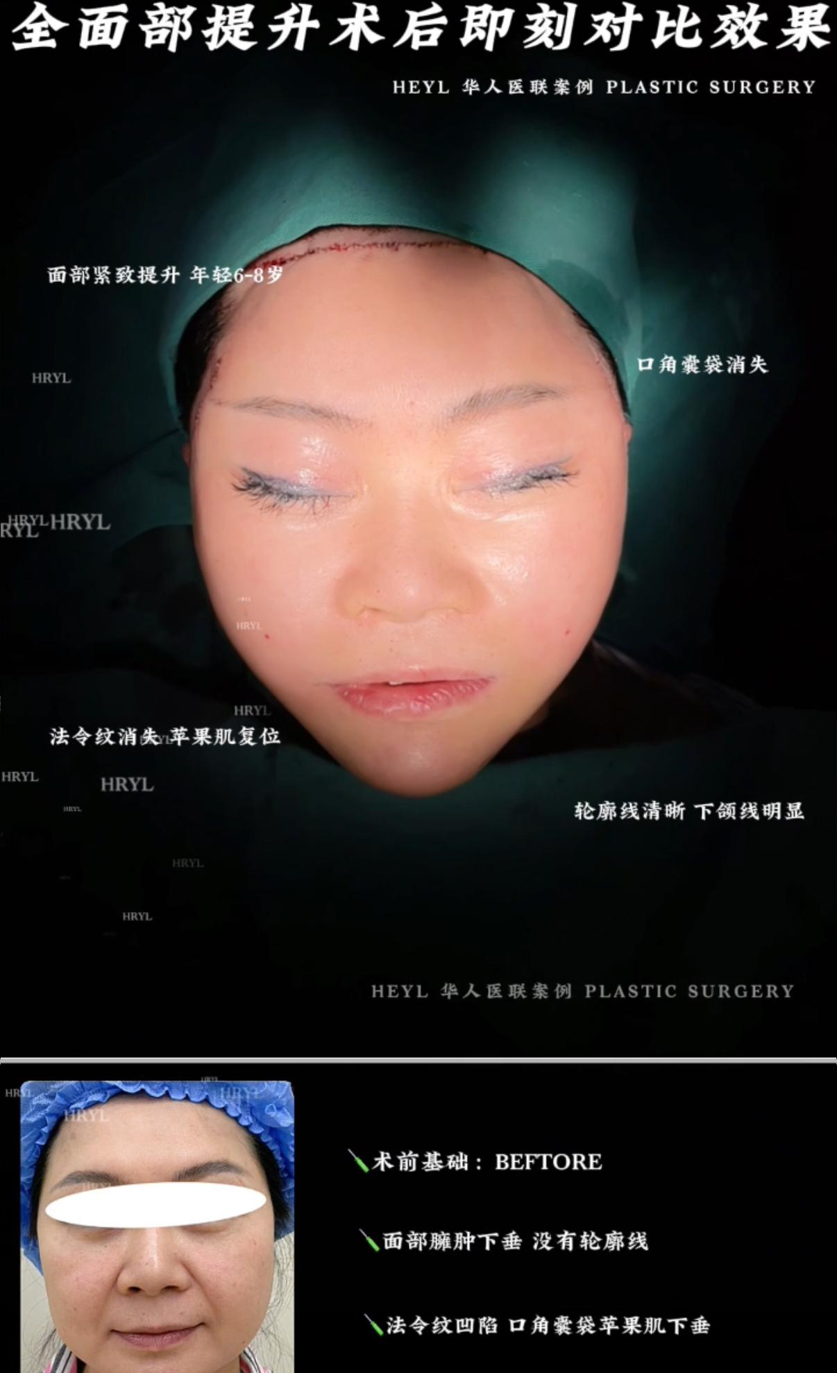 轮廓整形案例 07