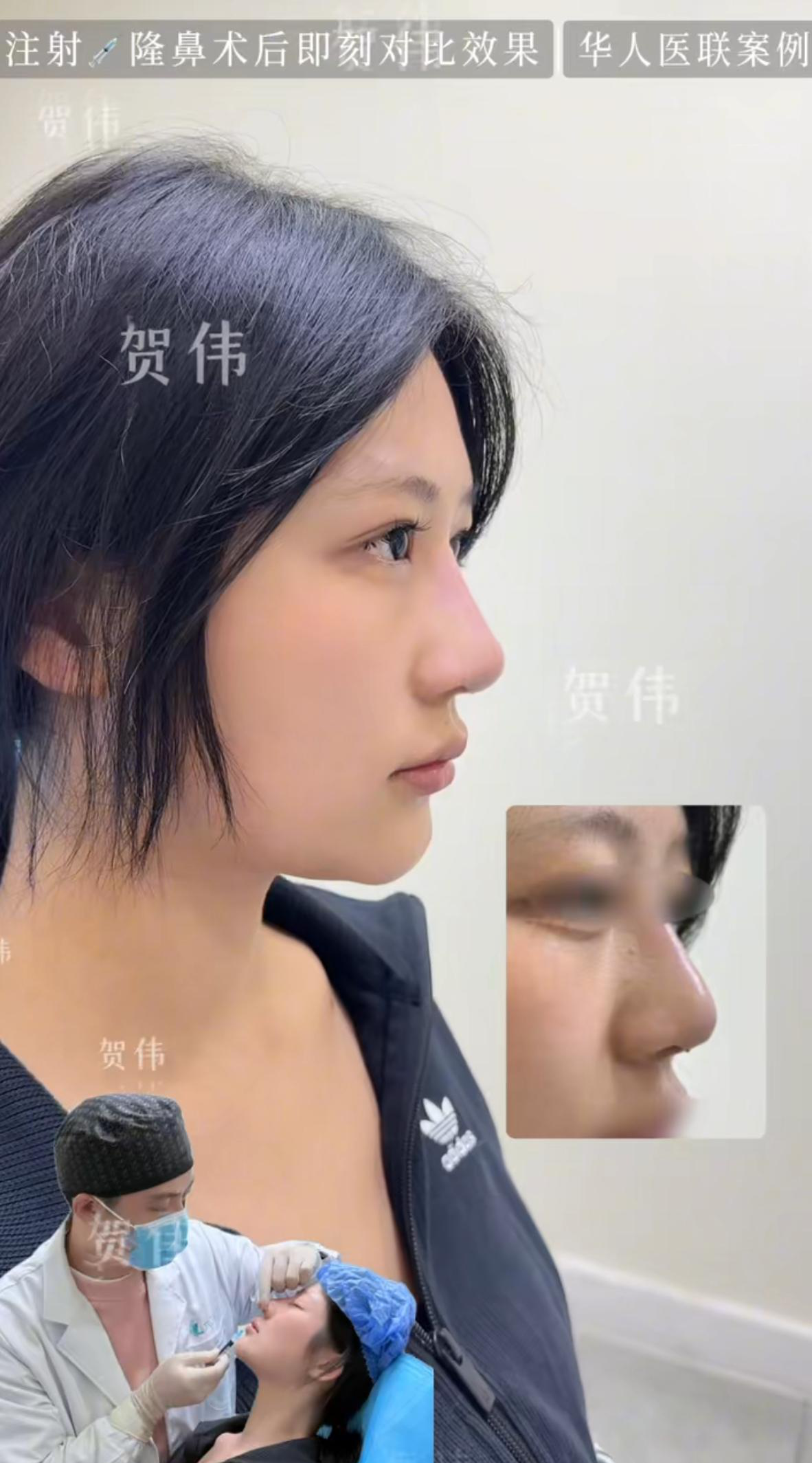 注射案例 02