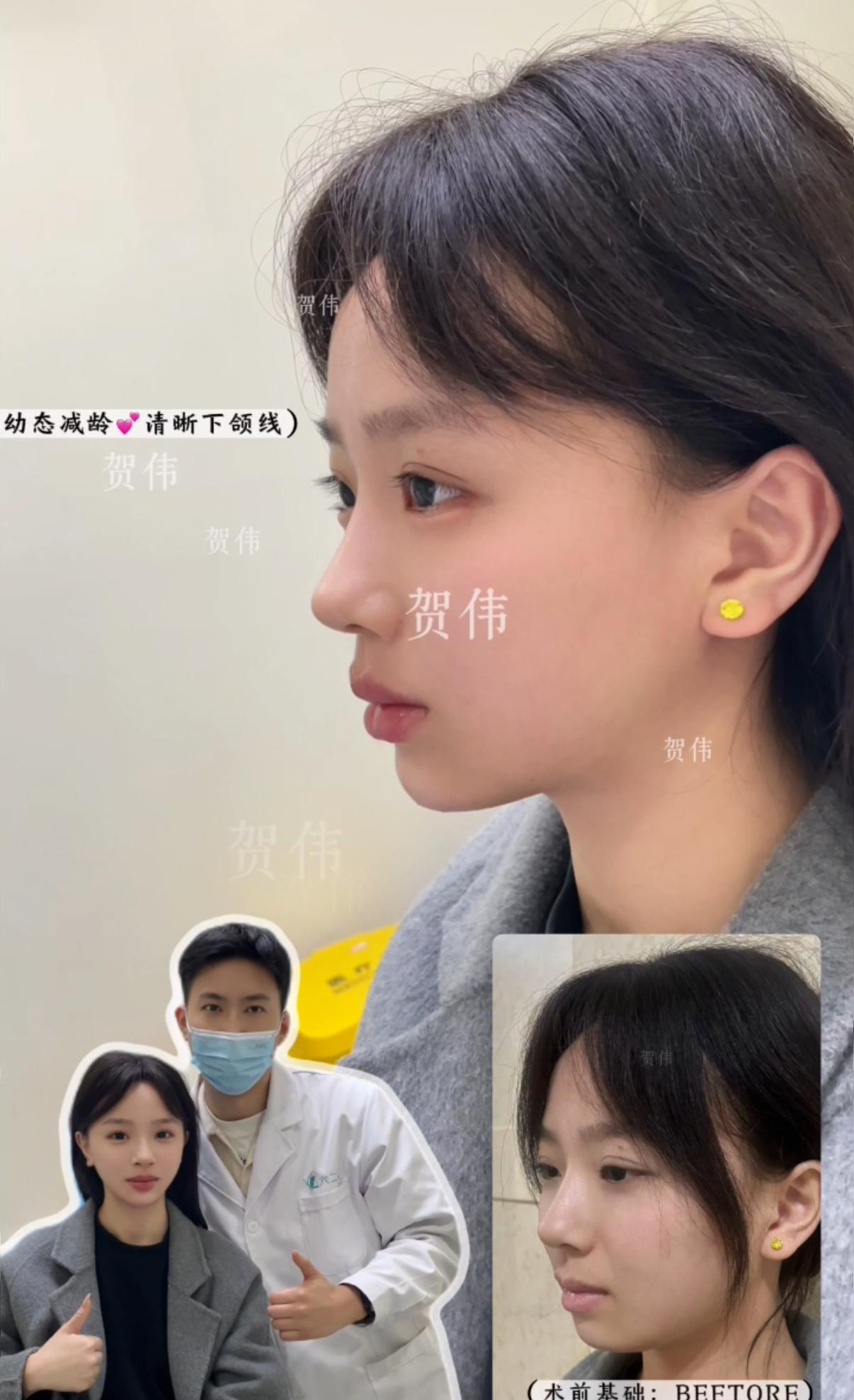 注射案例 04